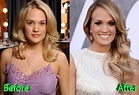 Carrie Underwood Plastic Surgery: Looking Better Than Ever