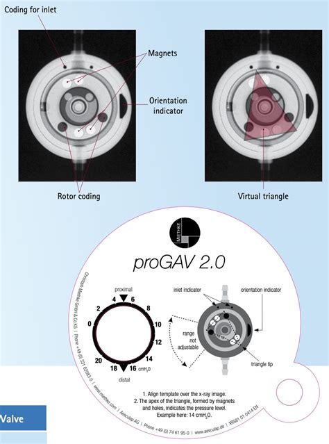 Brg Reading Skull Films For Shunt Valve Settings