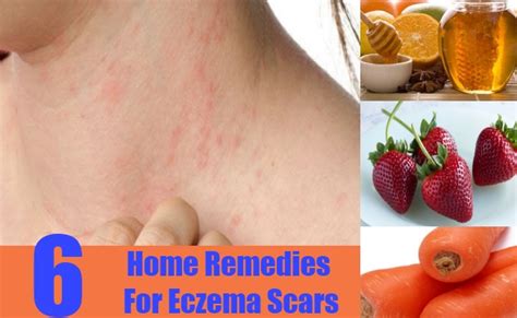 6 Eczema Scars Home Remedies Natural Treatments And Cure