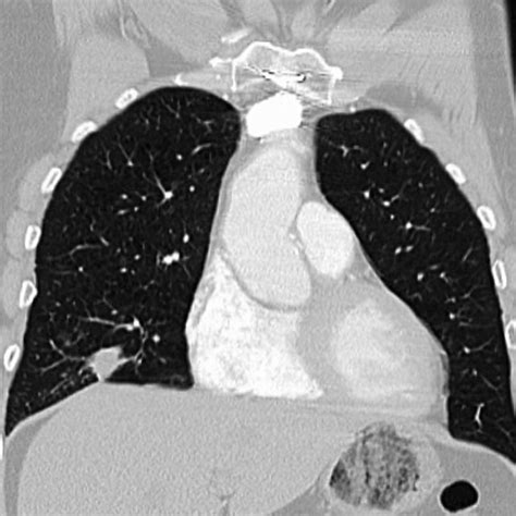 E Coronal Contrast Enhanced Ct Chest Right Middle Lobe Lung Nodule