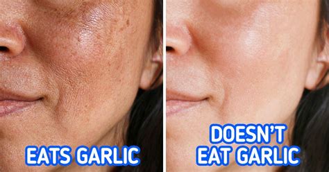 What Causes Skin Pigmentation And 3 Ways To Avoid It