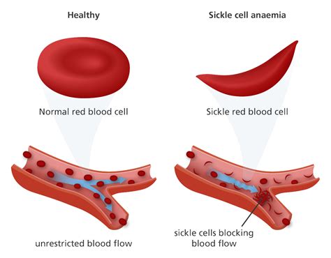 What Is Sickle Cell Disorder Sickle Cell Foundation Nigeria