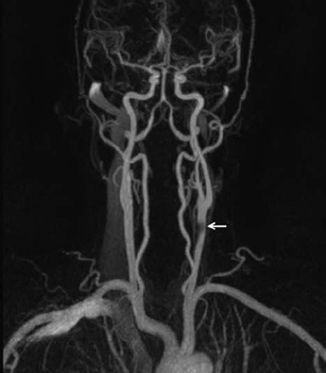 Magnetic Resonance Angiography Disclosed A Critical Stenosis At The