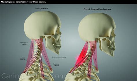 Vagus Nerve Compression In The Neck Symptoms And Treatments Caring