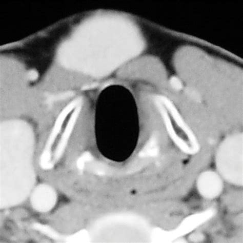 Imaging Of Ectopic Thyroid Tissue And Thyroglossal Duct Cysts