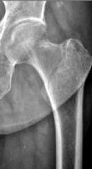 Femoral Neck Fractures Trauma Orthobullets