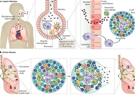 Pathogenesis Of Mycobacterium Tuberculosis