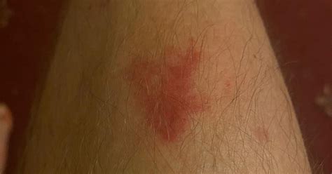 Horsefly Bite Picture Shows What It Looks Like How To Avoid Them How
