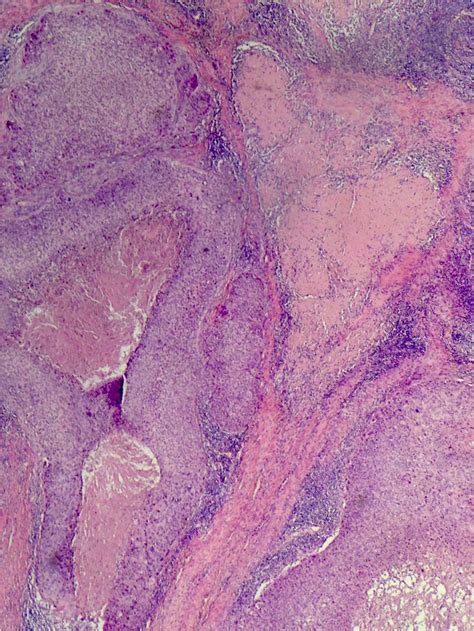 Microcystic Adnexal Carcinoma Infiltrating Tubules And Cords In