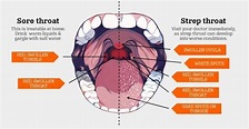 Differences Between Strep Throat and Tonsillitis | Vikram ENT Hospital