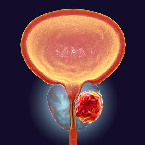 It is one of the most common types of cancer. Potential Metastatic Prostate Cancer Biomarker Identified