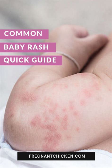 Types Of Baby Rashes Baby Rash Baby Diaper Rash Rashes Remedies