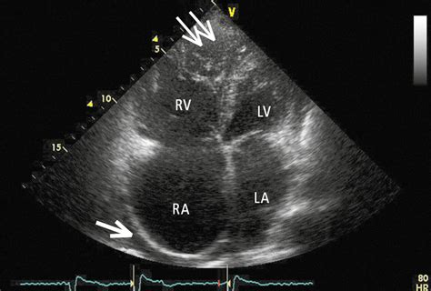 Figure Transthoracic Echocardiography Tte Of A Patient With