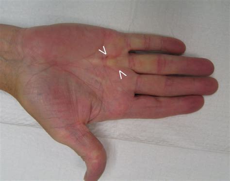 Nonsurgical Treatment Dupuytrens Contracture