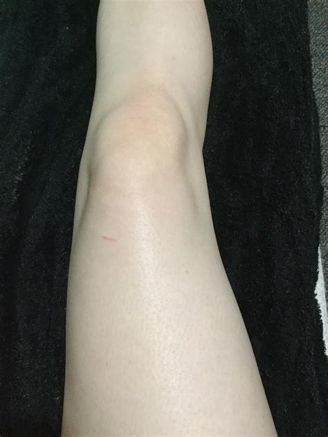 Razor Bumps On Legs