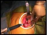 Side Incision Knee Replacement Surgery Pictures