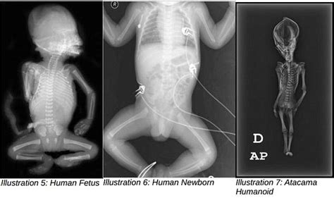 Mummy Of A Atacama Space Alien With A Cone Shaped Head Is Human