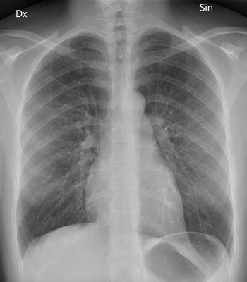 How To Interpret Chest X Rays Essential Methods
