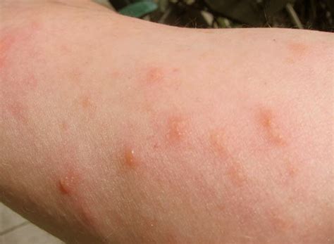 Poison Oak Rash Good Health