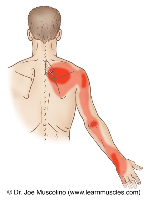 Serratus Posterior Superior Trigger Points Learn Muscles