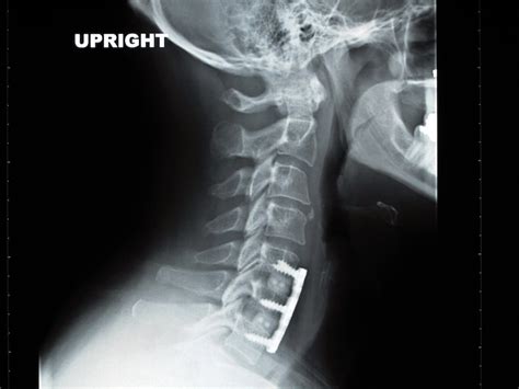 Anterior Cervical Discectomy And Fusion Allspine Laser And Surgery Center
