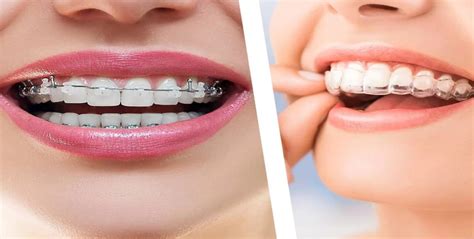 Smile Transformation Decoded Invisalign Vs Traditional Braces Pros And Cons