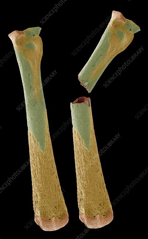 Osteoporotic Bones Sem Stock Image C0337107 Science Photo Library