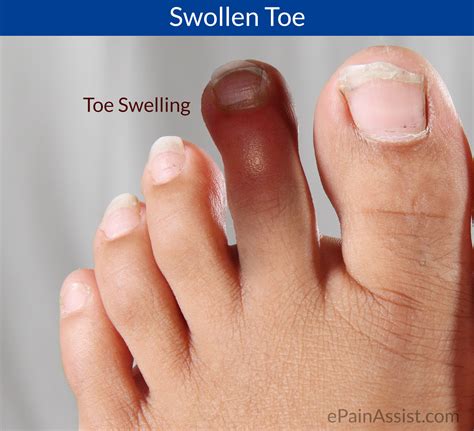 Toe Pain Causes And Treatment
