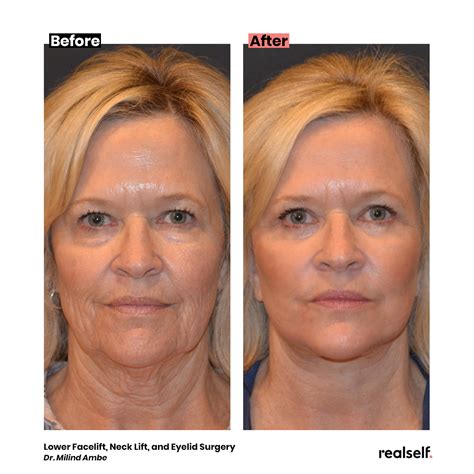 Botox For Hooded Eyelids Before And After