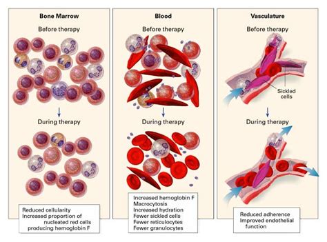 Management Of Sickle Cell Disease Nejm