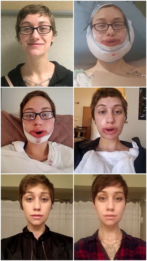 My Journey From Pre Double Jaw Surgery To 4 Weeks Post Surgery Plus A
