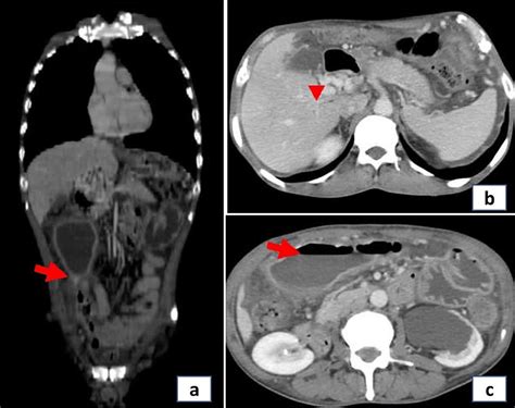 Contrast Enhanced Ct Abdomen Images A Arrow Pointing To A Stricture