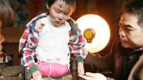 Boy Suffers From Rare Skin Condition Butterfly Boy Youtube