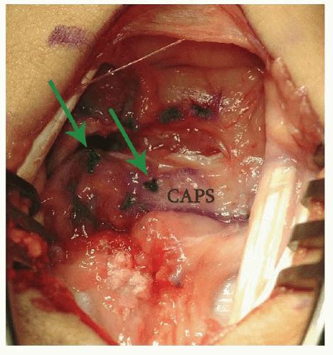 Open Scapholunate Ligament Repair And Augmentation