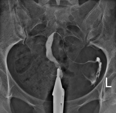 Unicornuate Uterus Radiology Case Radiopaedia Org