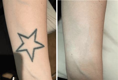 Tattoo Removal Before And After Before And After Photos Of Tattoo