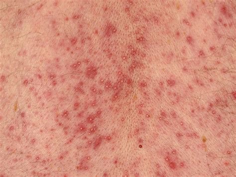 Papular Pustular Rash Differential Painful White Bump On The Side Of