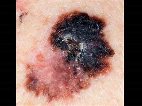 Fico 15 Elenchi Di Melanoma Malignant Skin Cancer Images This Is