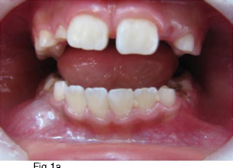 Unicystic Ameloblastoma In 8 Years Old Child A Case Report Review Of