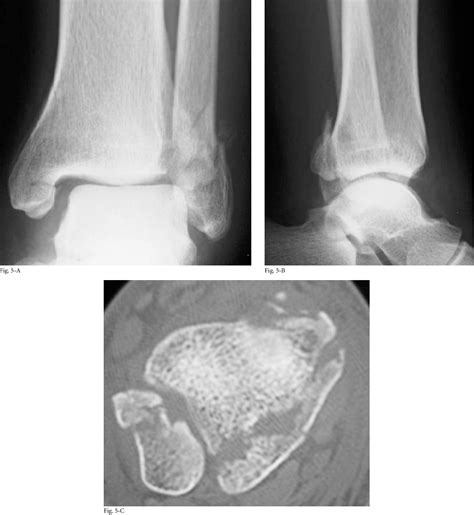 Figure From Pathoanatomy Of Posterior Malleolar Fractures Of The Ankle Semantic Scholar