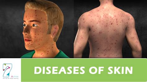 Diseases Of Skin Youtube