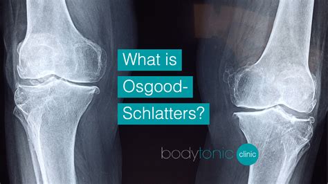 Osgood Schlatter Disease X Ray