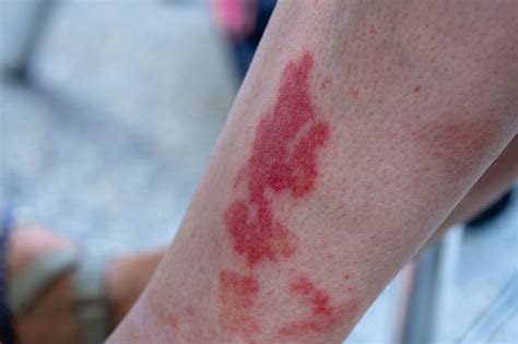 9 Signs Your Mystery Rash Is Something Serious Factspedia