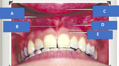 Ch 10 Vestibule And Vestibular Tissue Of The Oral Cavity Flashcards