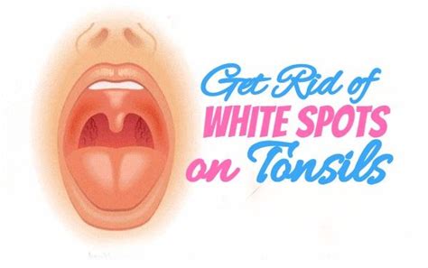 How To Get Rid Of White Spots On Tonsils How To Get Rid Of White Spots