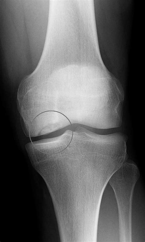 Anteroposterior Radiograph Of Knee With A Medial Femoral Condyle Download Scientific Diagram