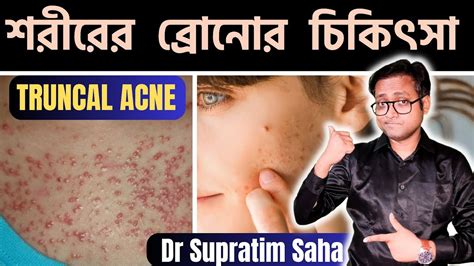 ব্রণ বা Pimples কি শুধু মুখে হয় Truncal Acne Treatment Bengali Dr Supratim Saha Youtube