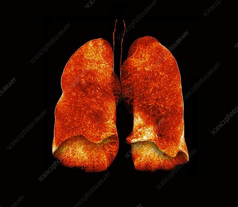 Emphysema Ct Scan Stock Image C0488757 Science Photo Library