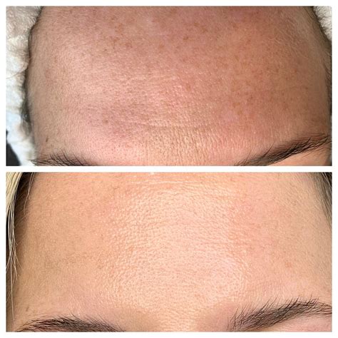 Best Hydrafacial In Denver Hydrafacial Before And After — Mooi