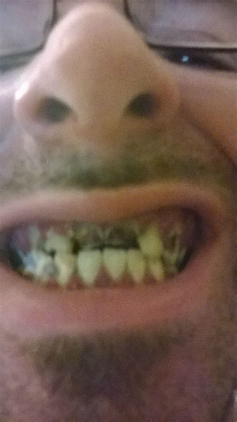 You should honestly let your dad know. UpdateMy teeth hurt so bad that I feel like death is the ...